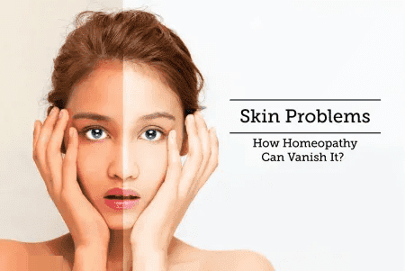 Homeo Treatment for skinproblem